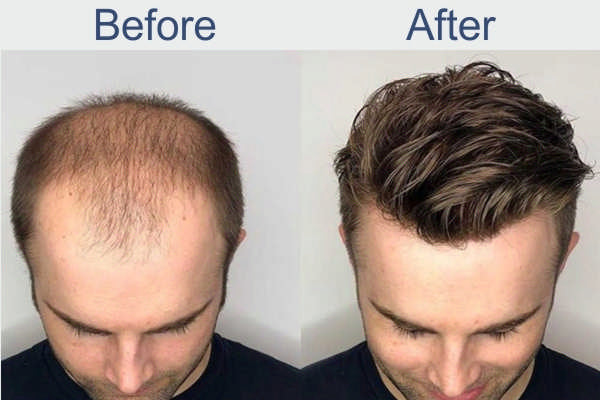 EliteInfuse™ Hair Regrowth System