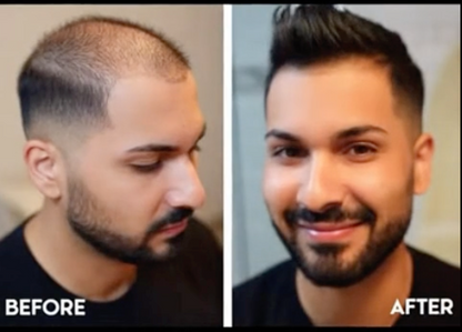 EliteInfuse™ Hair Regrowth System