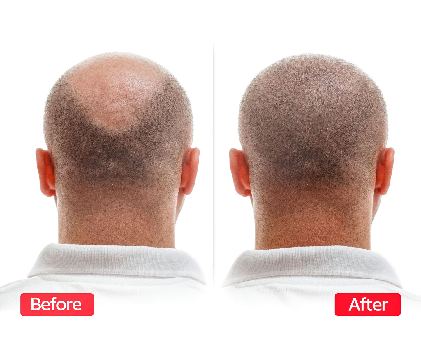 EliteInfuse™ Hair Regrowth System