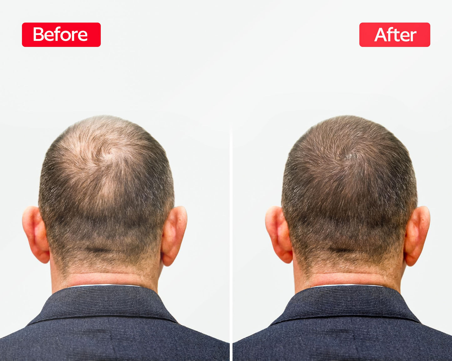 EliteInfuse™ Hair Regrowth System