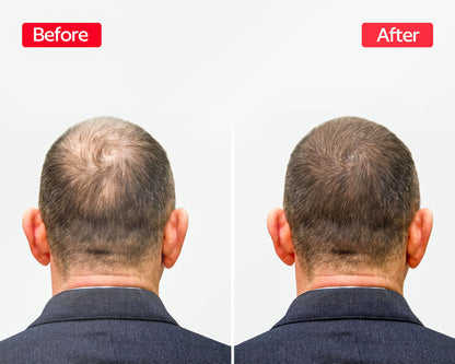 EliteInfuse™ Hair Regrowth System