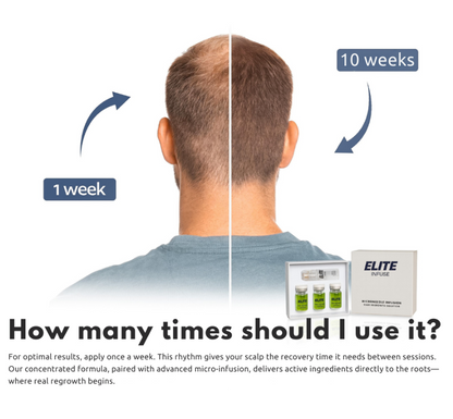 EliteInfuse™ Hair Regrowth System