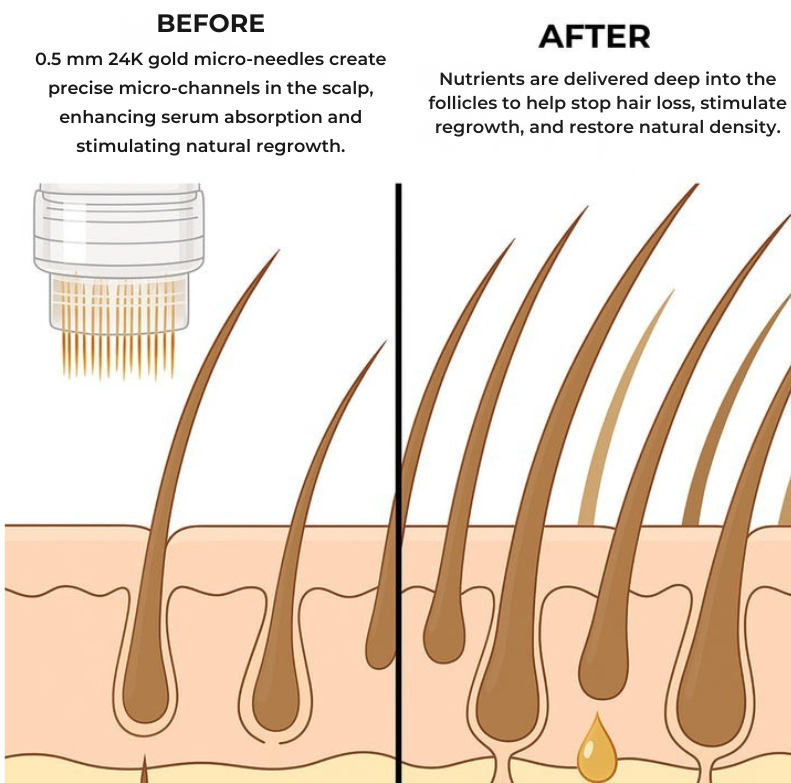 EliteInfuse™ Hair Regrowth System - Elite Infuse
