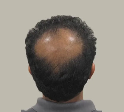 EliteInfuse™ Hair Regrowth System